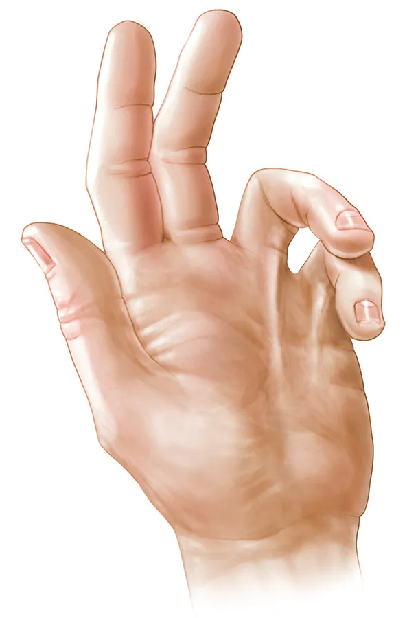 Contractura de Dupuytren
