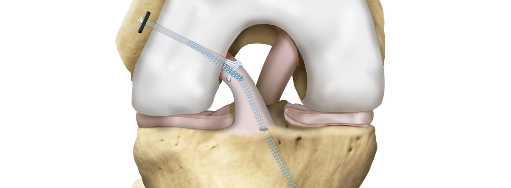 InternalBrace