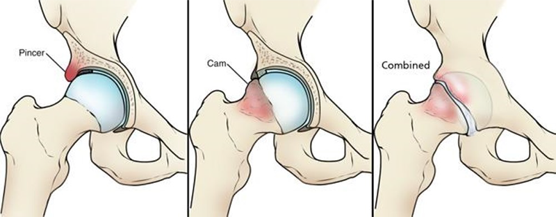 Dolor de cadera: Pinzamiento femoroacetabular